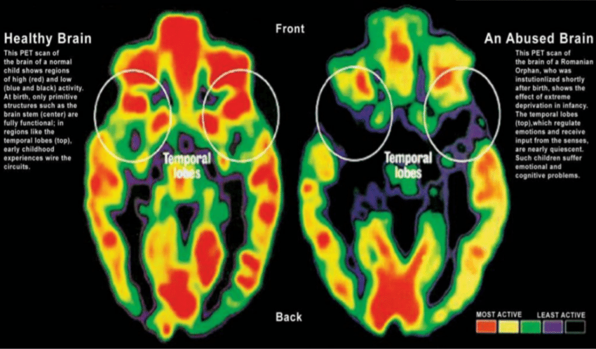 Healthy vs Abused Brain